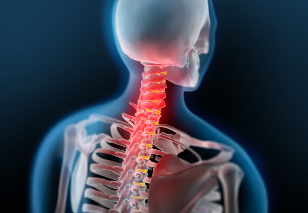 Wer unter dem HWS-Syndrom (Halswirbelsäulensyndrom, auch Zervikalsyndrom genannt) leidet, der leidet unter unangenehmen Schmerzen und mitunter auch Funktionsstörungen im Hals- und Nackenbereich.